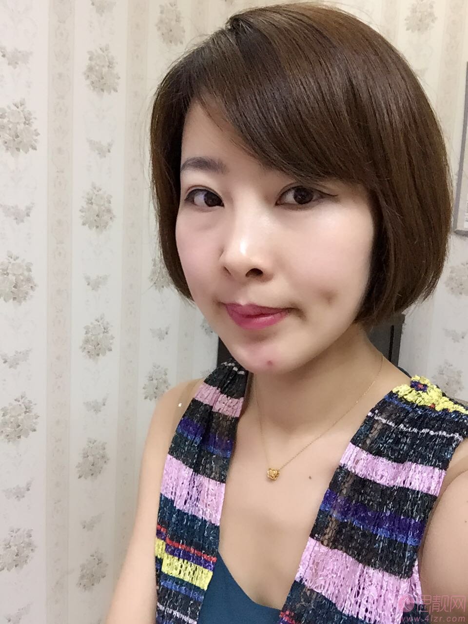 沈阳百嘉丽医疗美容医院价格表，及全切双眼皮效果一览