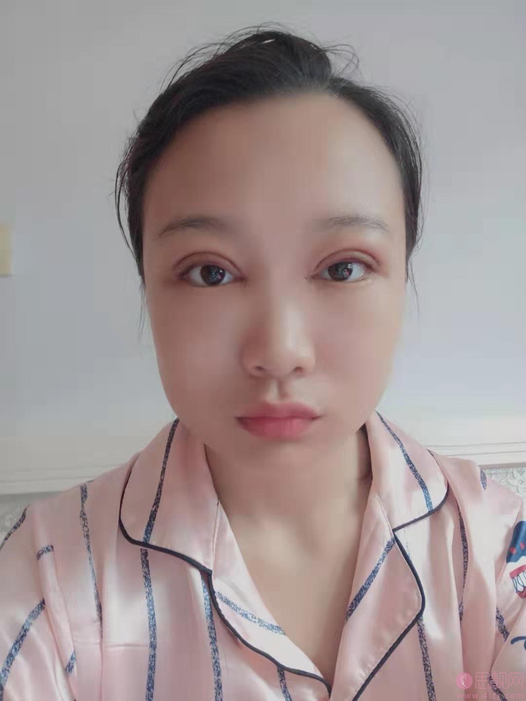 淄博美联臣美容整形医院路卫国医生靠谱吗？附双眼皮案例一览