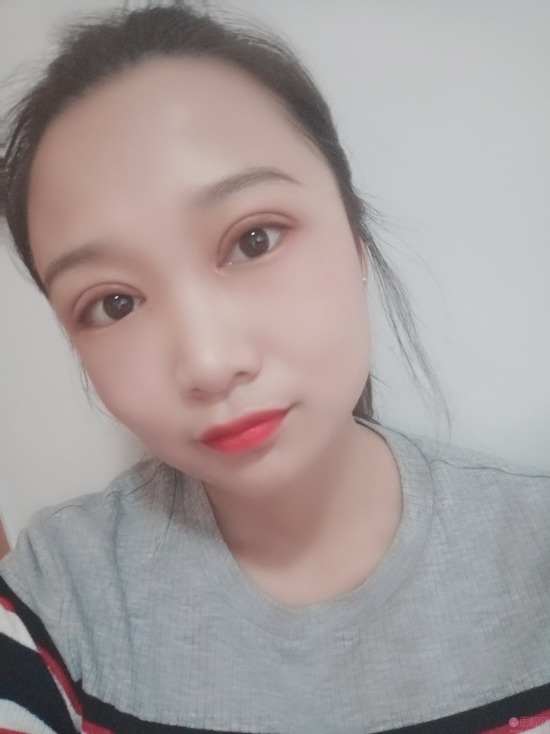 淄博美联臣美容整形医院路卫国医生靠谱吗？附双眼皮案例一览