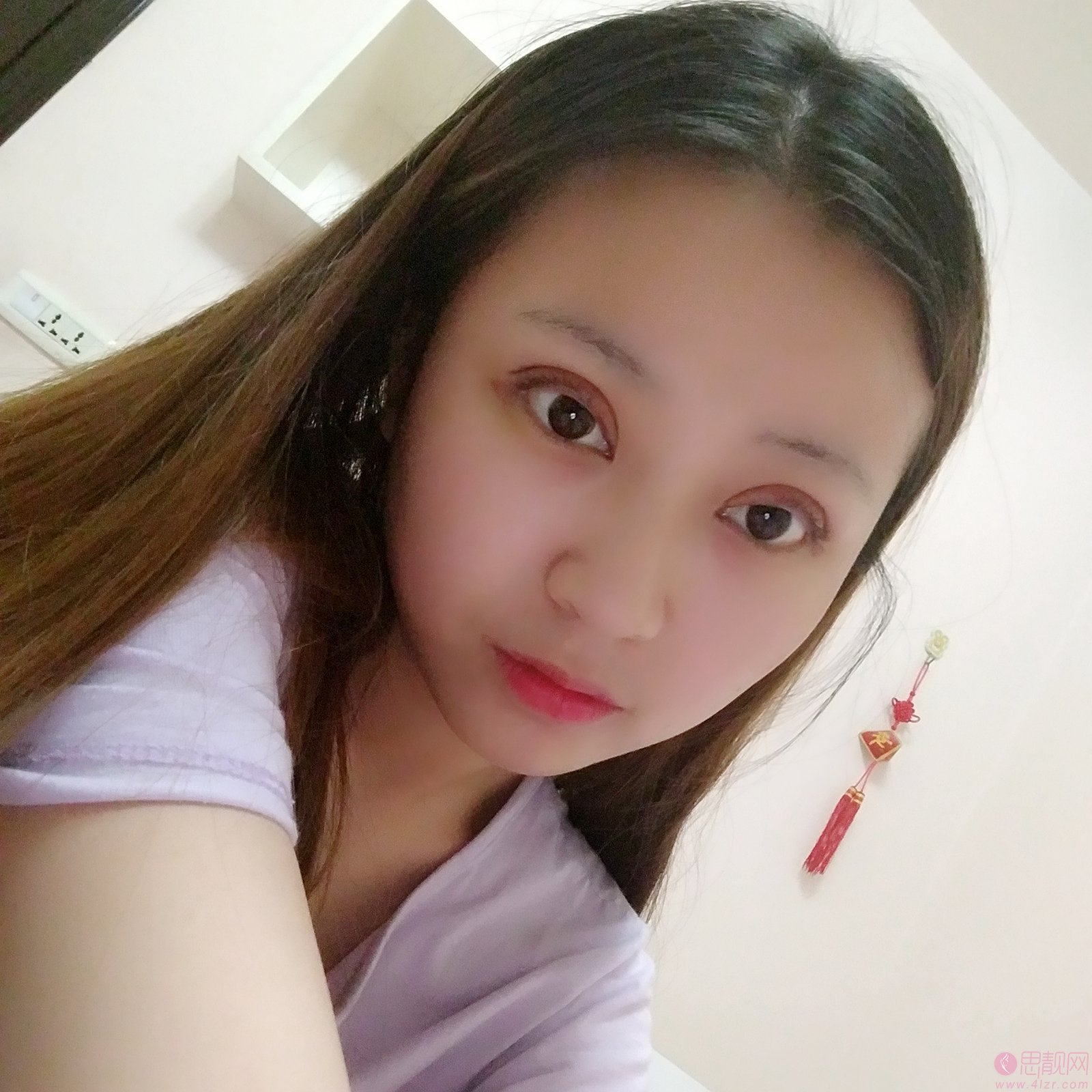 深圳军科医疗美容门诊部刘月更医生做双眼皮怎么样？附双眼皮真人案例一览