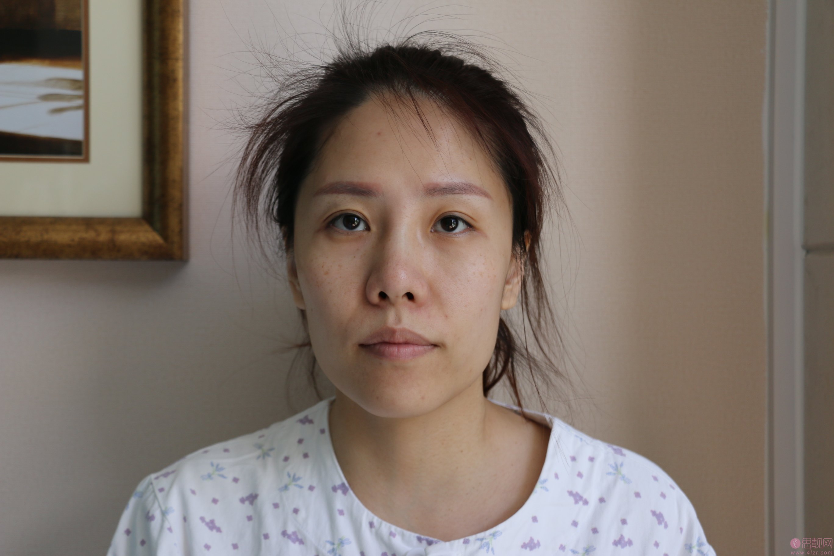 邯郸华美医疗美容医院张晓亮隆鼻怎么样？附隆鼻真人案例及医院价格表