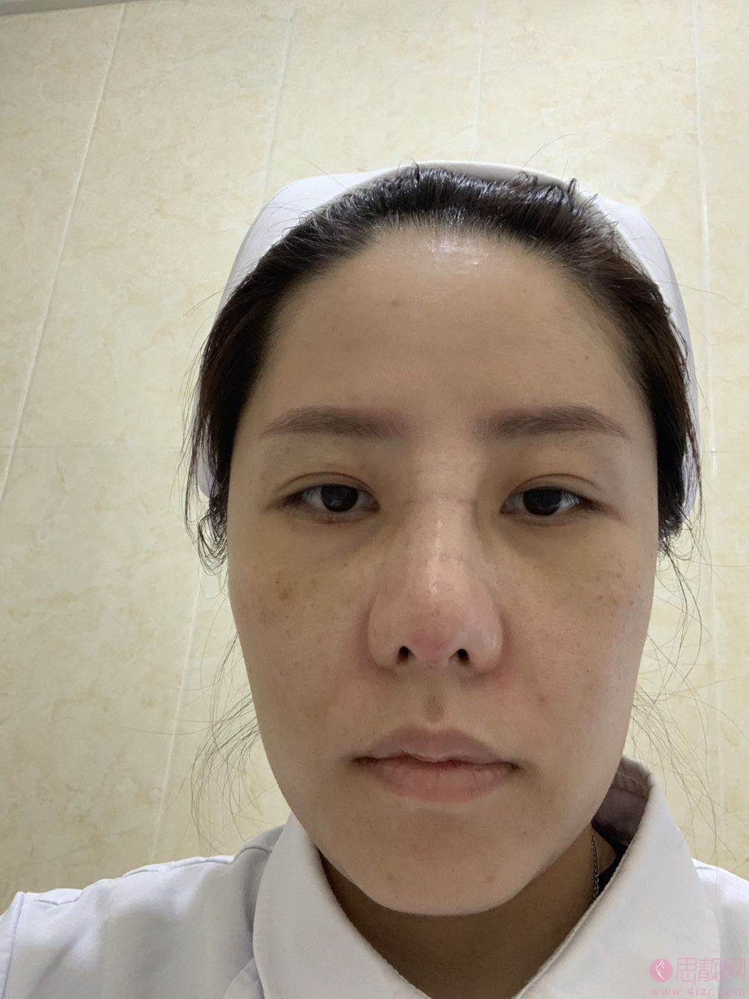 邯郸华美医疗美容医院张晓亮隆鼻怎么样？附隆鼻真人案例及医院价格表
