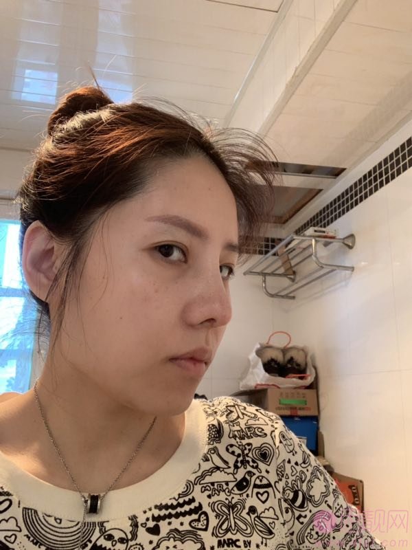 邯郸华美医疗美容医院张晓亮隆鼻怎么样？附隆鼻真人案例及医院价格表