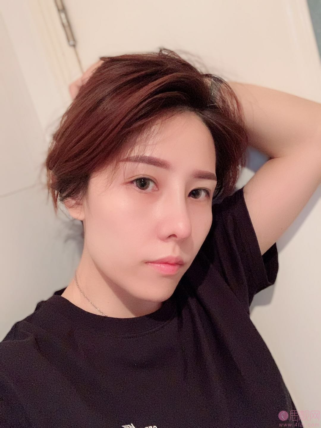 邯郸华美医疗美容医院张晓亮隆鼻怎么样？附隆鼻真人案例及医院价格表