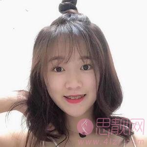 无锡坤如玛丽整形美容医院崔培培做双眼皮怎么样？附双眼皮真人案例一览