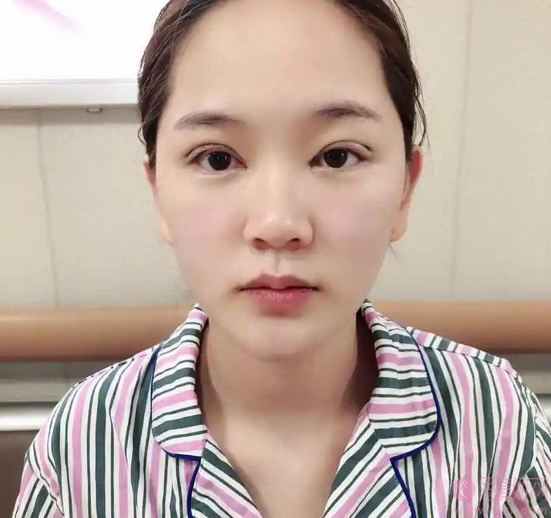 无锡坤如玛丽整形美容医院崔培培做双眼皮怎么样？附双眼皮真人案例一览