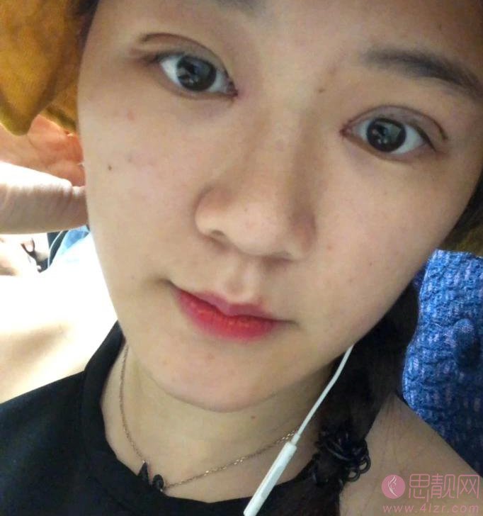 无锡坤如玛丽整形美容医院崔培培做双眼皮怎么样？附双眼皮真人案例一览