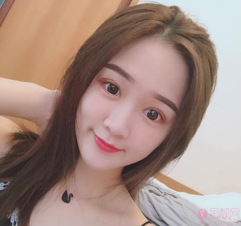 无锡坤如玛丽整形美容医院崔培培做双眼皮怎么样？附双眼皮真人案例一览