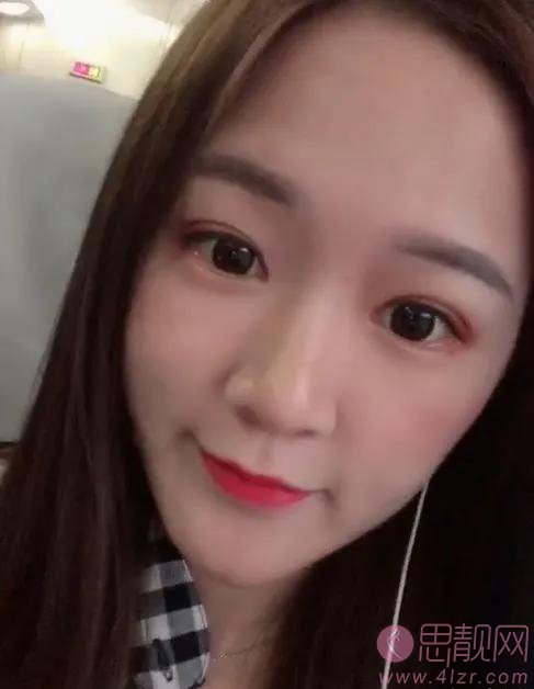 无锡坤如玛丽整形美容医院崔培培做双眼皮怎么样？附双眼皮真人案例一览