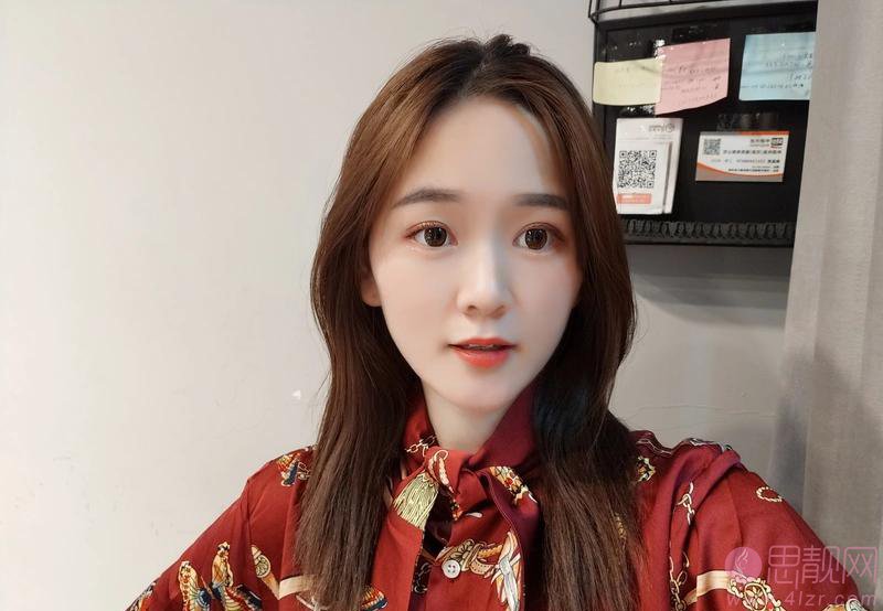 无锡坤如玛丽整形美容医院崔培培做双眼皮怎么样？附双眼皮真人案例一览