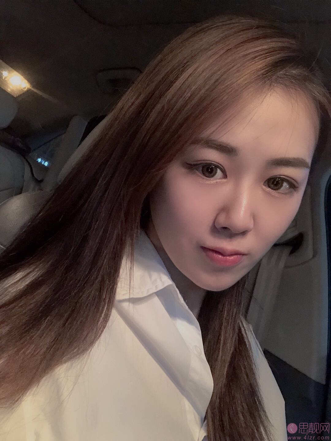 广州伊丽莎白医疗美容医院做双眼皮怎么样？附双眼皮案例及价格表