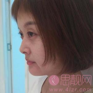 珠海韩妃医疗美容余传伟做隆鼻怎么样？附隆鼻真人案例一览