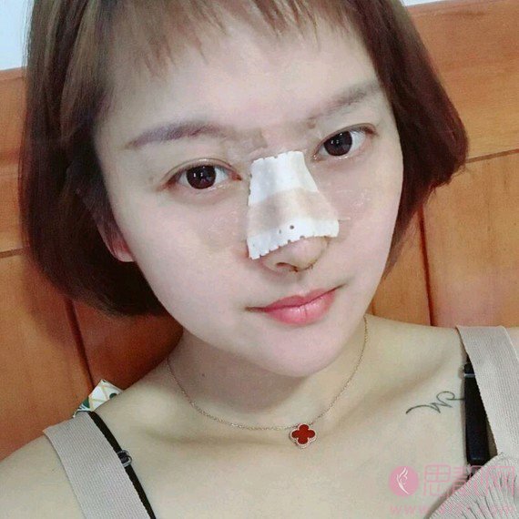 珠海韩妃医疗美容余传伟做隆鼻怎么样？附隆鼻真人案例一览