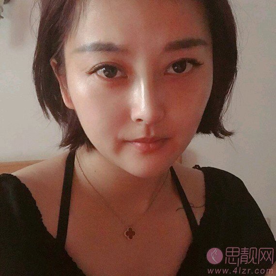 珠海韩妃医疗美容余传伟做隆鼻怎么样？附隆鼻真人案例一览