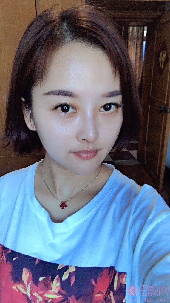 珠海韩妃医疗美容余传伟做隆鼻怎么样？附隆鼻真人案例一览