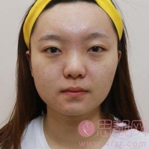 东莞维多利亚医疗美容陈志勇做隆鼻怎么样？附隆鼻案例及价格