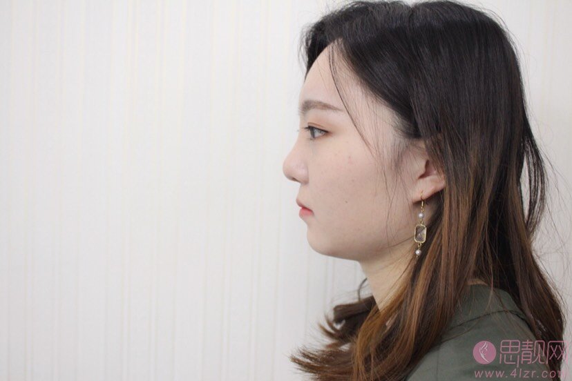东莞维多利亚医疗美容陈志勇做隆鼻怎么样？附隆鼻案例及价格