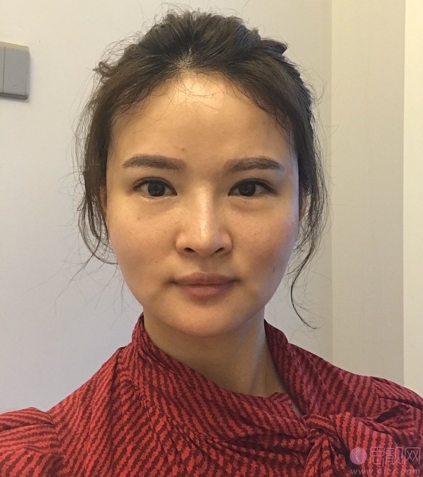 心悦容医疗美容门诊部倪云志隆鼻好不好？附隆鼻真人案例一览及价格表