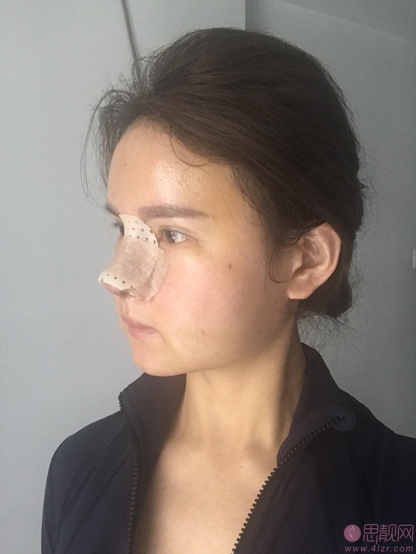 心悦容医疗美容门诊部倪云志隆鼻好不好？附隆鼻真人案例一览及价格表