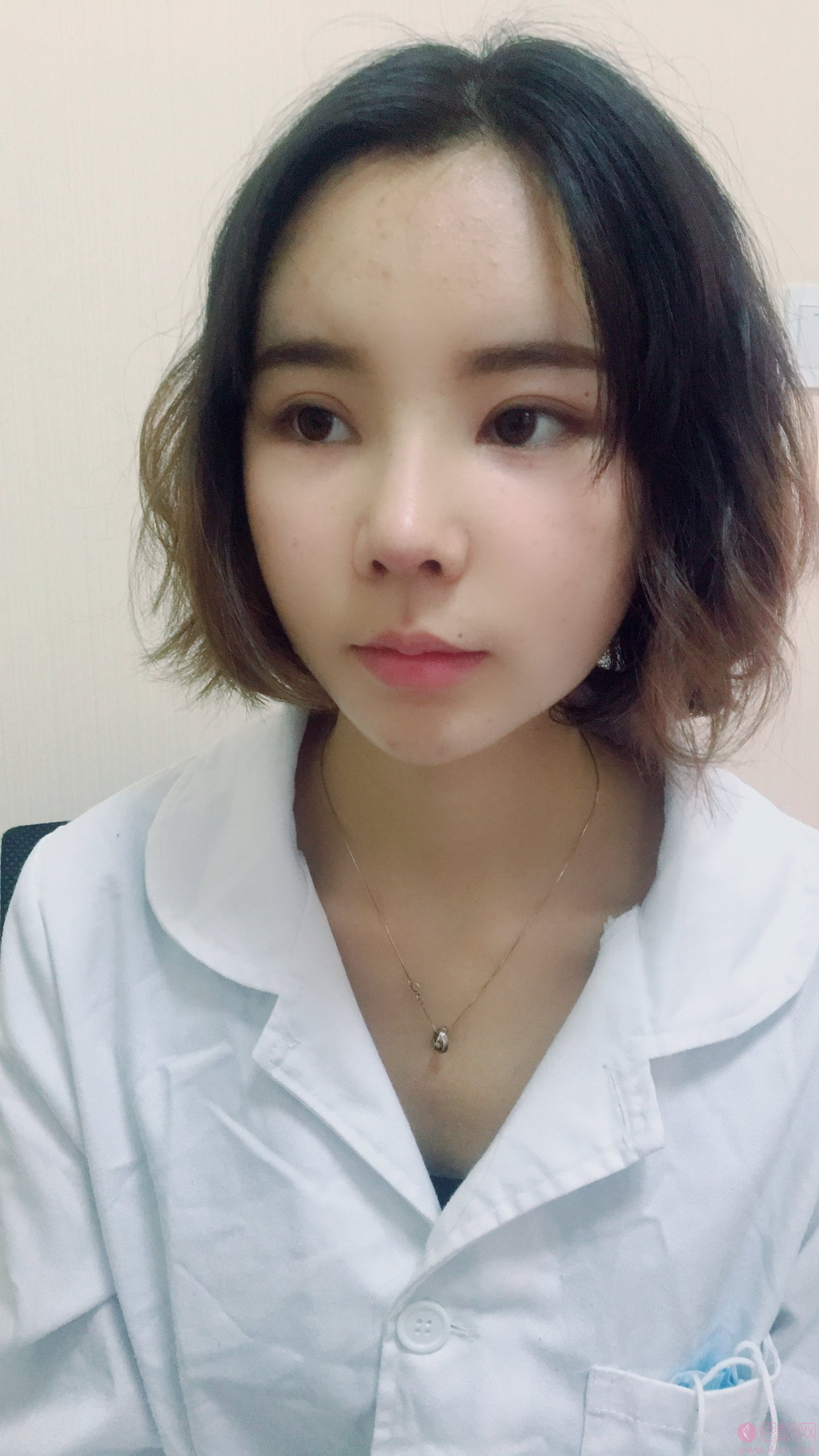 云南中医学院整形美容彭雅洁做驼峰鼻矫正怎么样？附驼峰鼻矫正案例