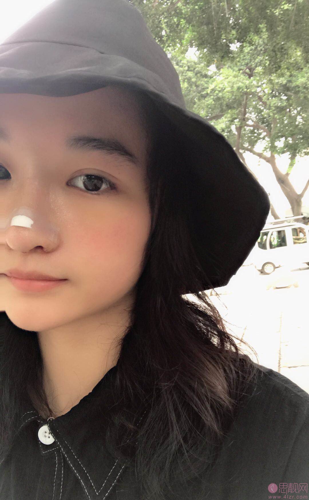 泉州海峡医疗美容郭永军隆鼻怎么样？附隆鼻案例及价格表