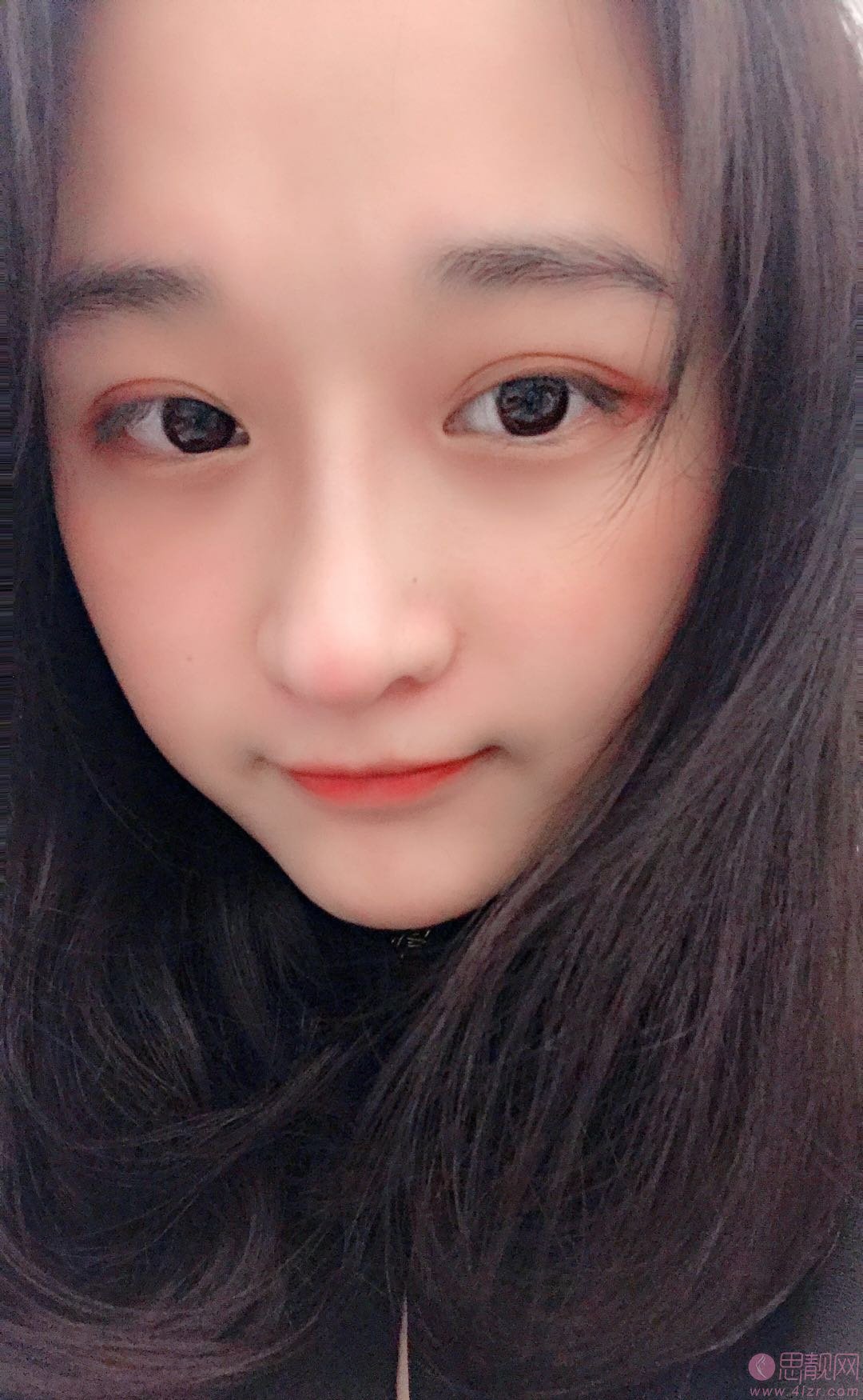 泉州海峡医疗美容郭永军隆鼻怎么样?附隆鼻案例及价格表