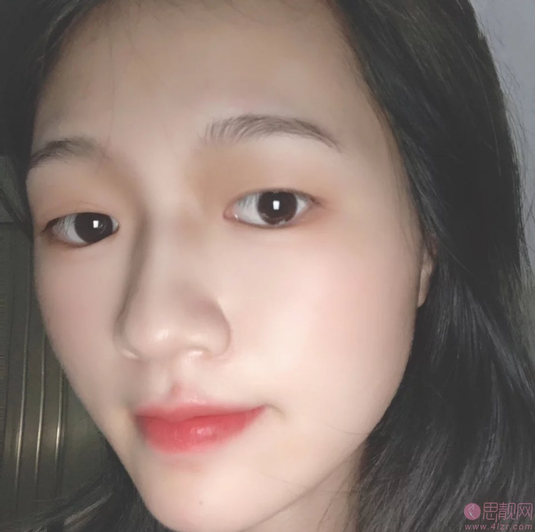 南京凤凰岛整形胡国强做双眼皮怎么样？附双眼皮案例一览及价格表查询