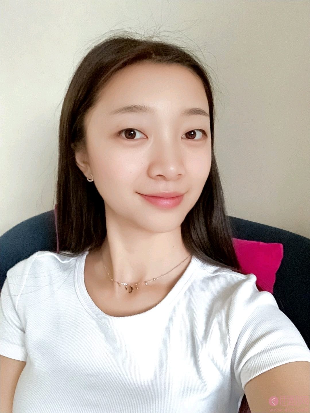 泉州西华医疗美容做双眼皮好不好?附双眼皮真人案例一览