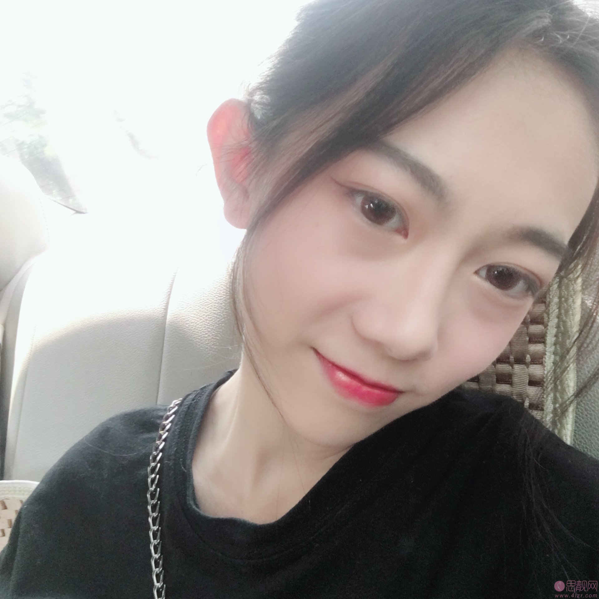 西安画美团圆口腔·牙齿矫正美容中心怎么样？附牙齿矫正案例一览