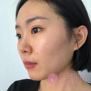 哈尔滨索菲医疗美容陈富全做鼻子怎么样？度隆鼻案例一览