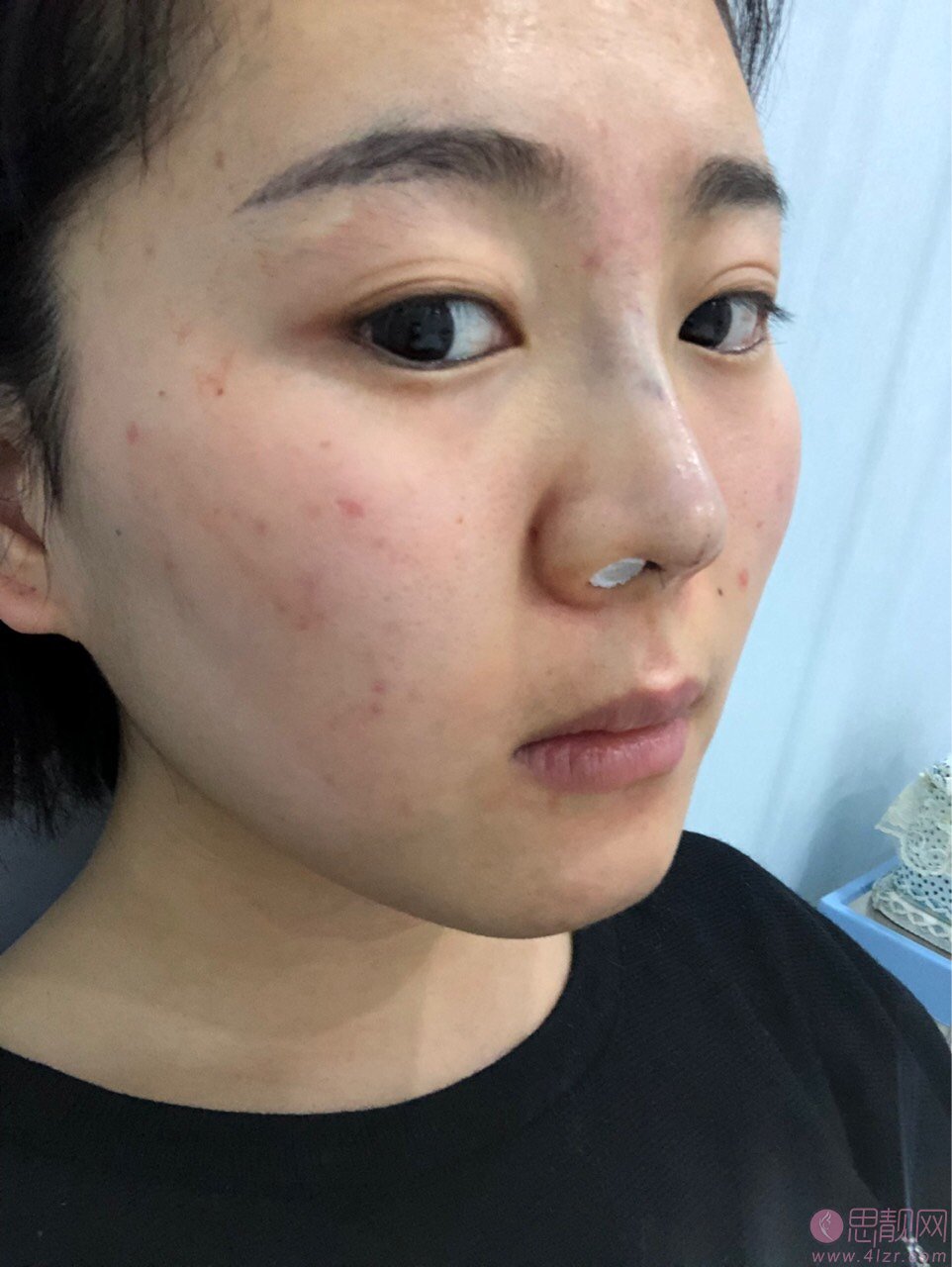 哈尔滨索菲医疗美容陈富全做鼻子怎么样？度隆鼻案例一览