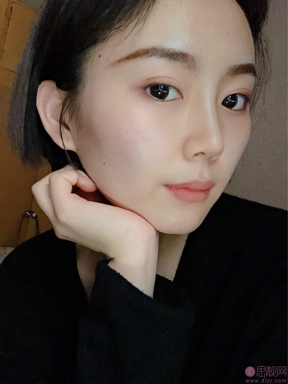 哈尔滨索菲医疗美容陈富全做鼻子怎么样？度隆鼻案例一览