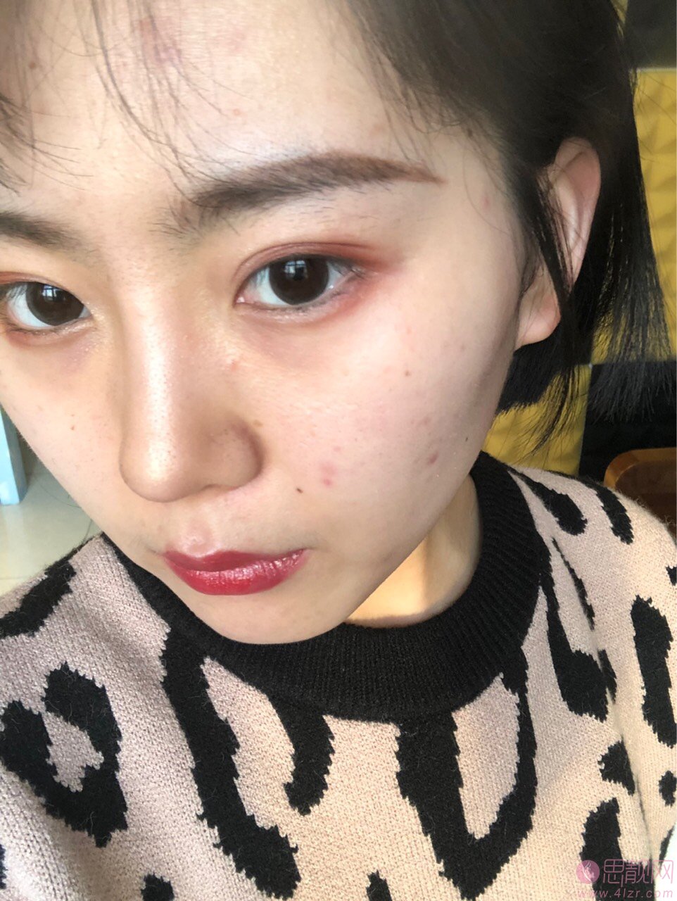 哈尔滨索菲医疗美容陈富全做鼻子怎么样？度隆鼻案例一览