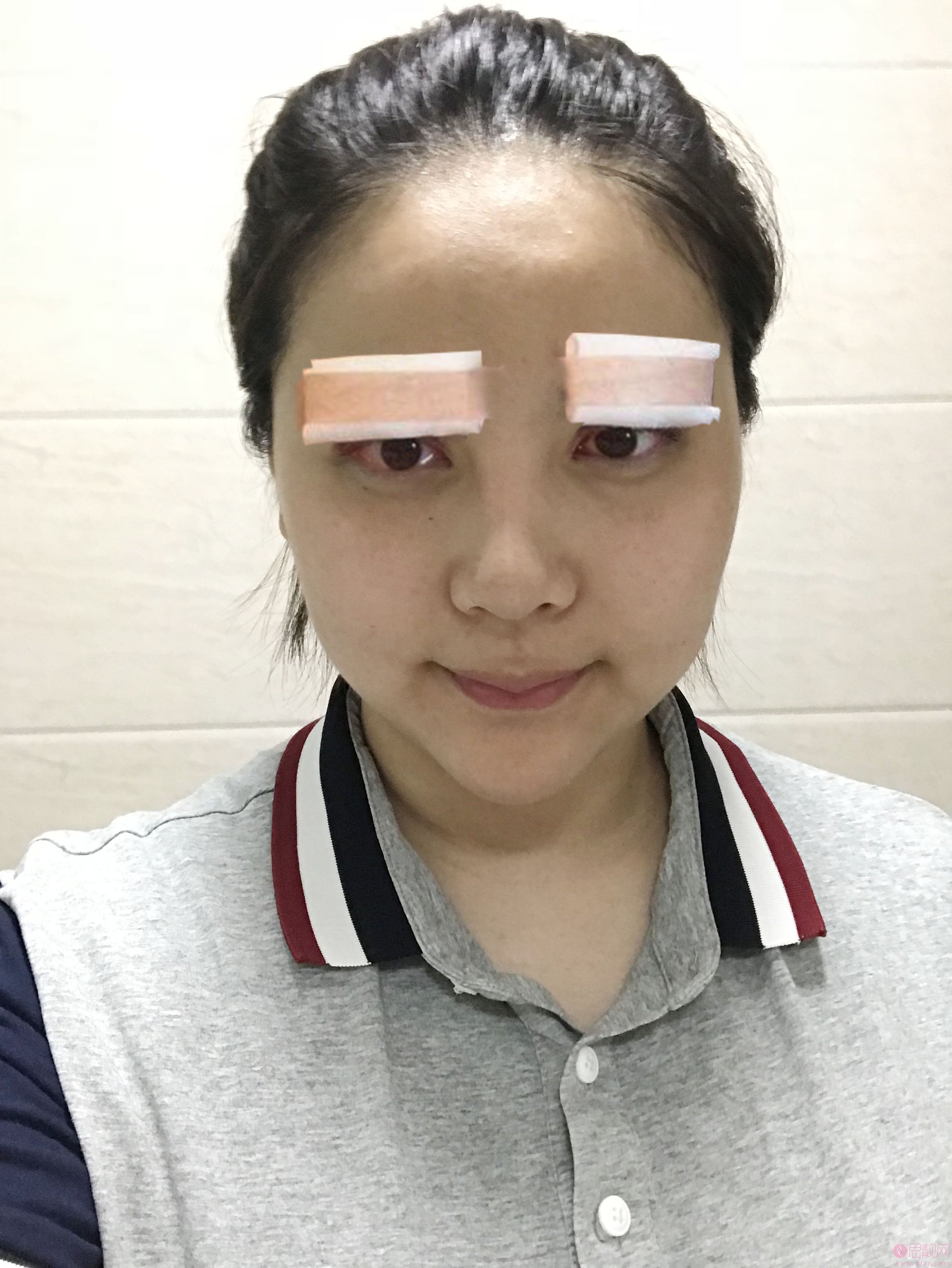青岛壹美天成整形美容医院杨宁双眼皮效果展示，附价格表
