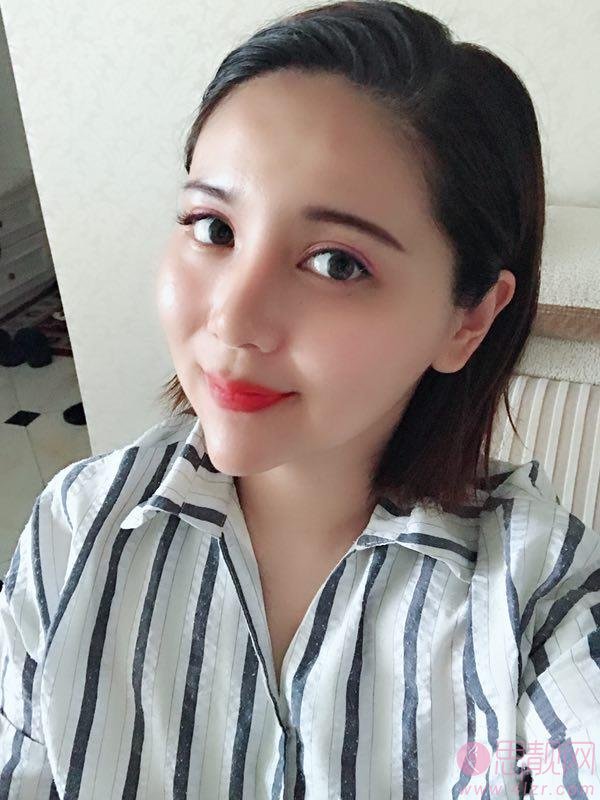 青岛壹美天成整形美容医院杨宁双眼皮效果展示，附价格表
