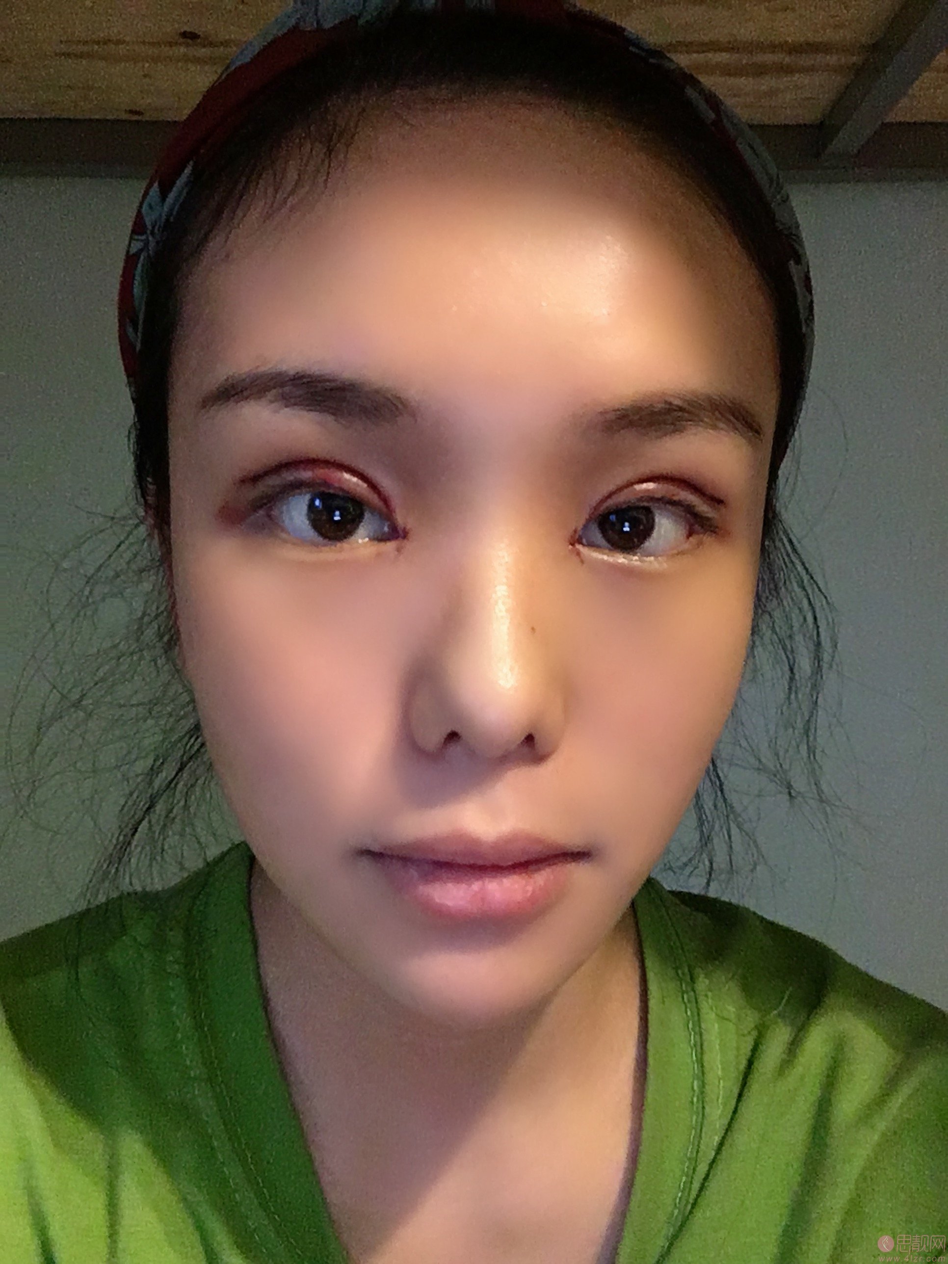 天津美莱石岩双眼皮效果案例展示，附双眼皮案例及价格表