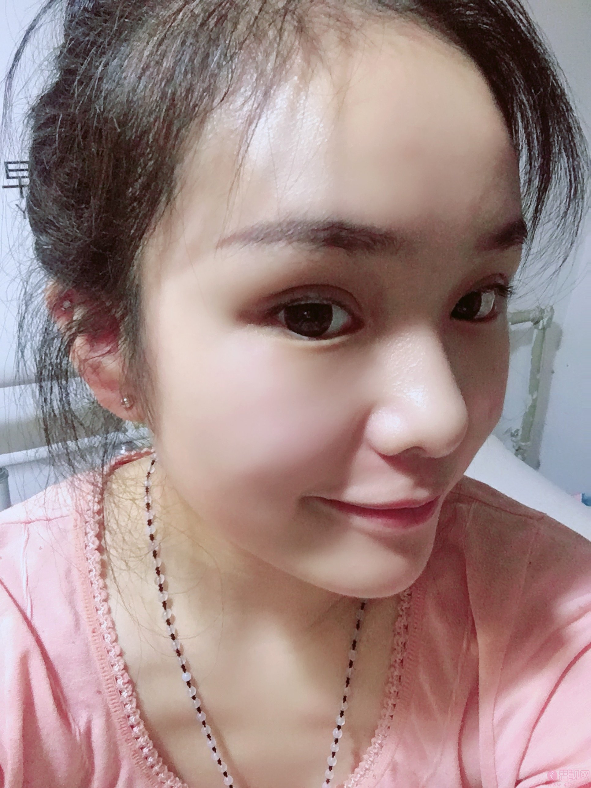 天津美莱石岩双眼皮效果案例展示，附双眼皮案例及价格表