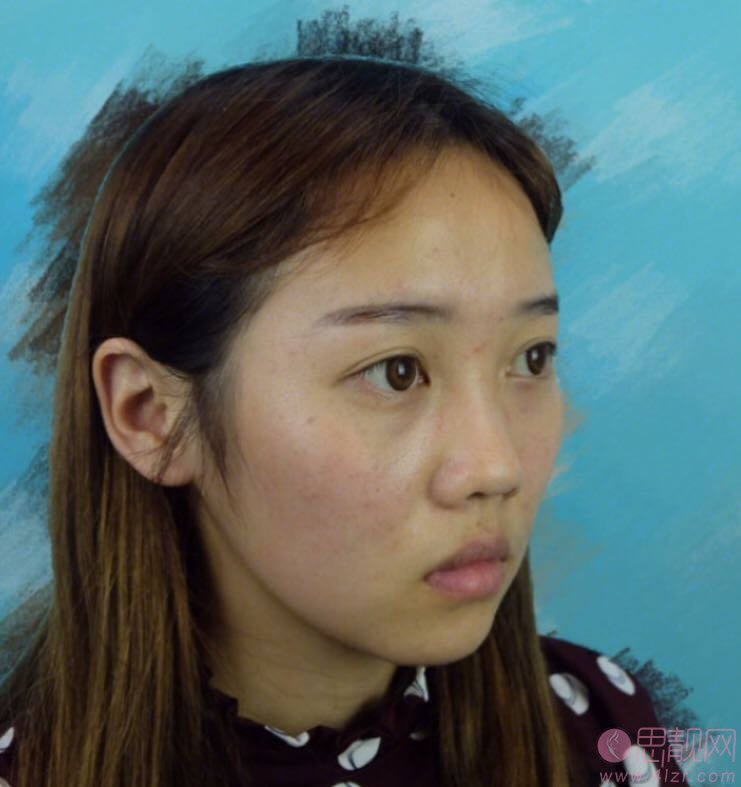 南京医科大学友谊整形外科医院林金德怎么样？附医院价格表及隆鼻案例一览