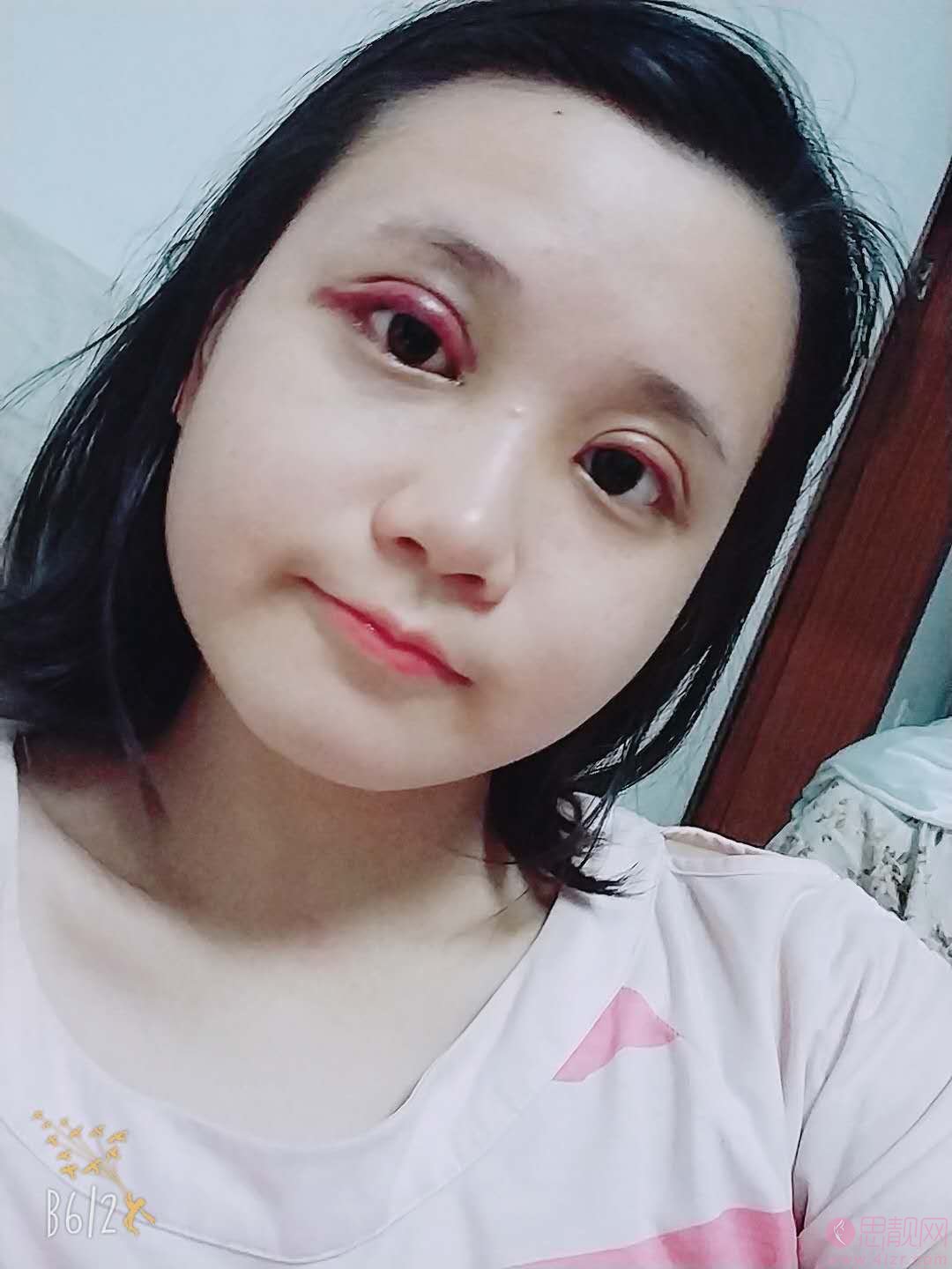 南充达芬奇董茂林双眼皮案例效果展示？附价格表