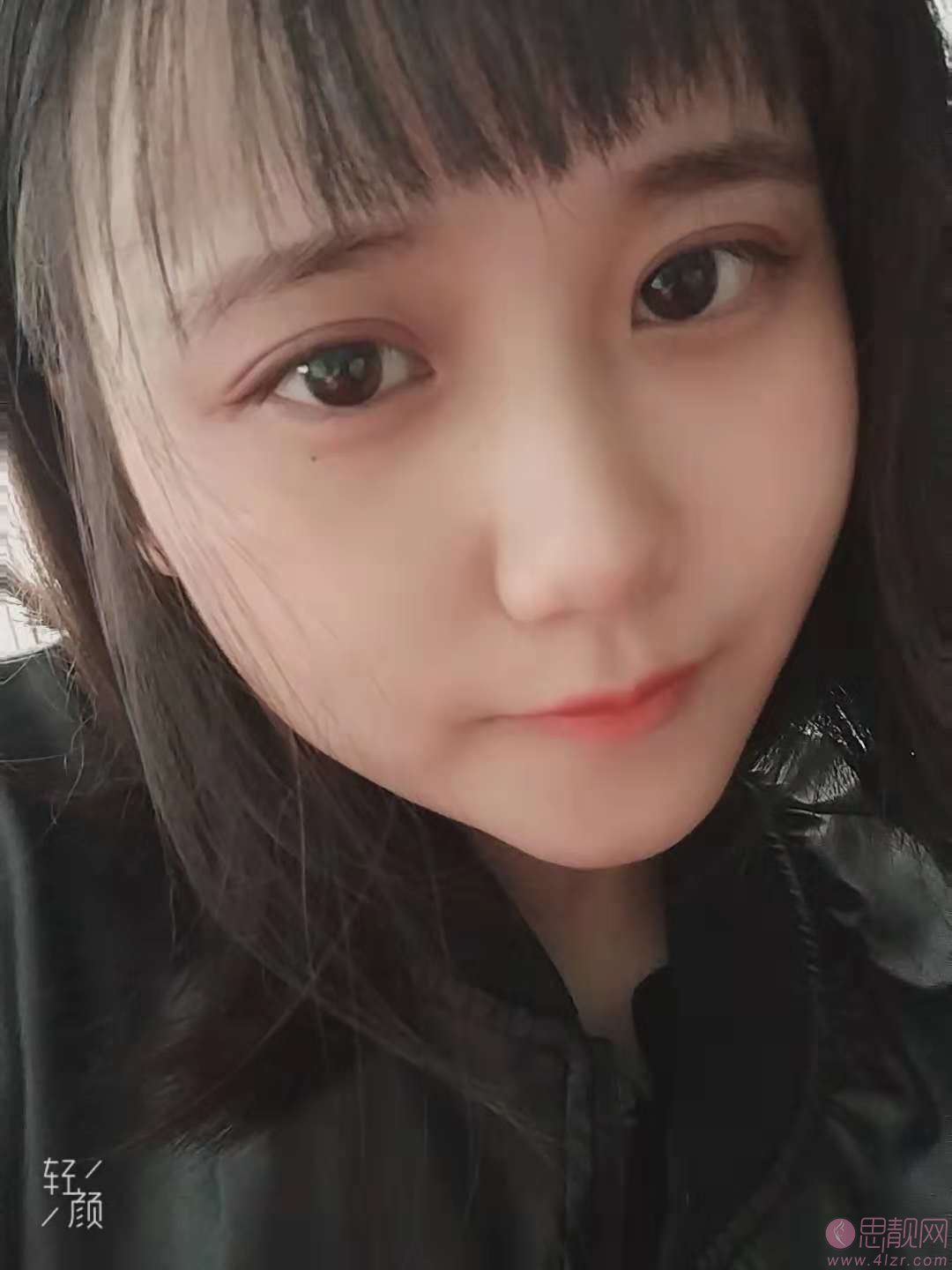南充达芬奇董茂林双眼皮案例效果展示？附价格表