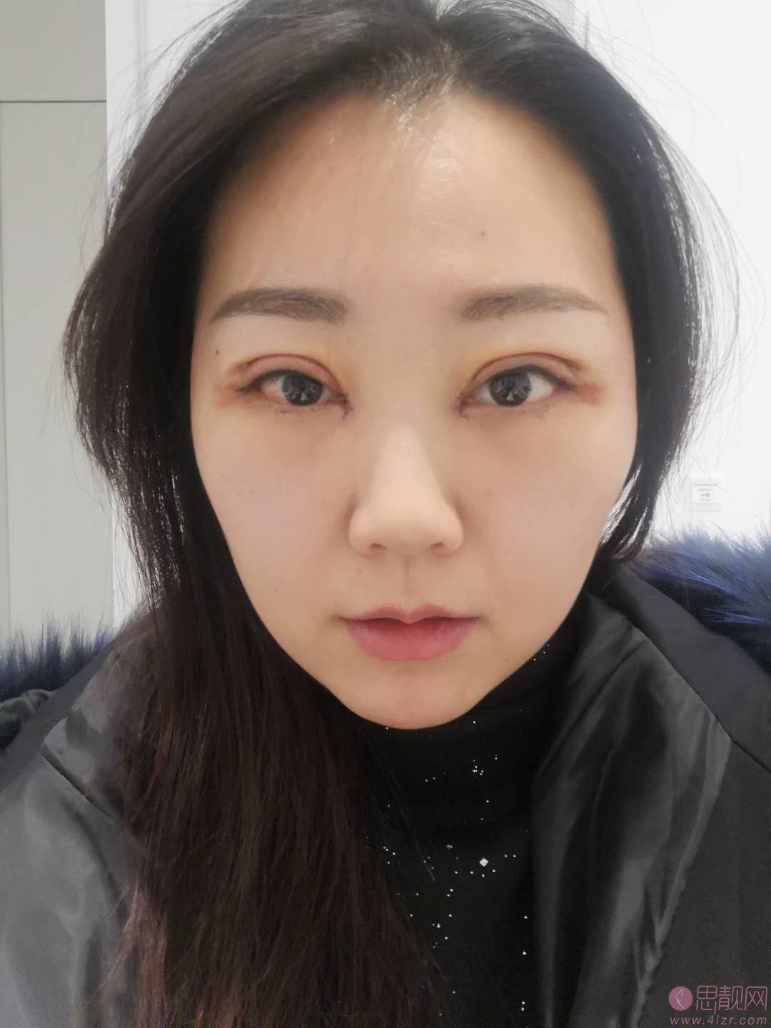 八大处陈江庭做双眼皮怎么样？附双眼皮案例一览