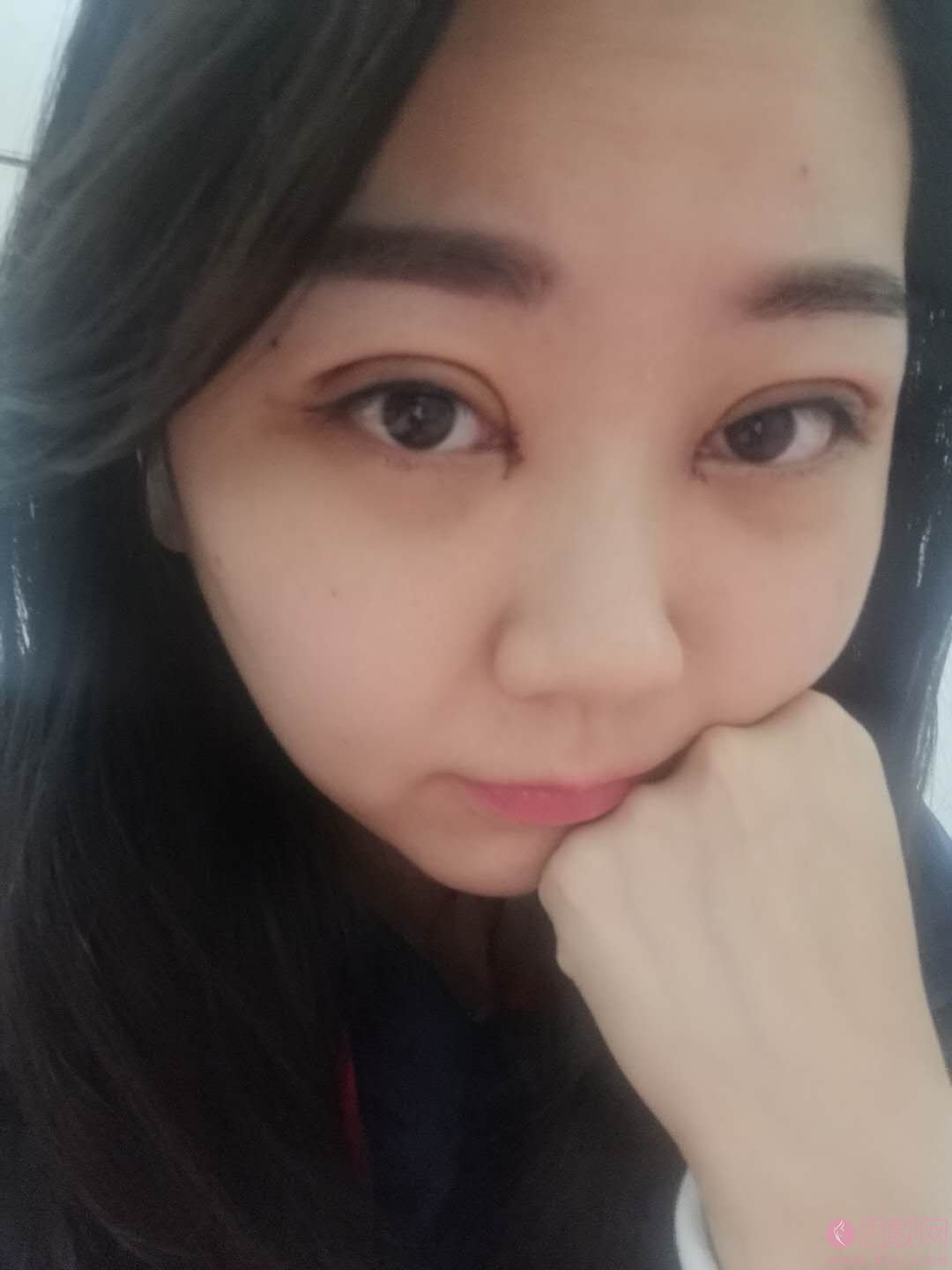 八大处陈江庭做双眼皮怎么样？附双眼皮案例一览