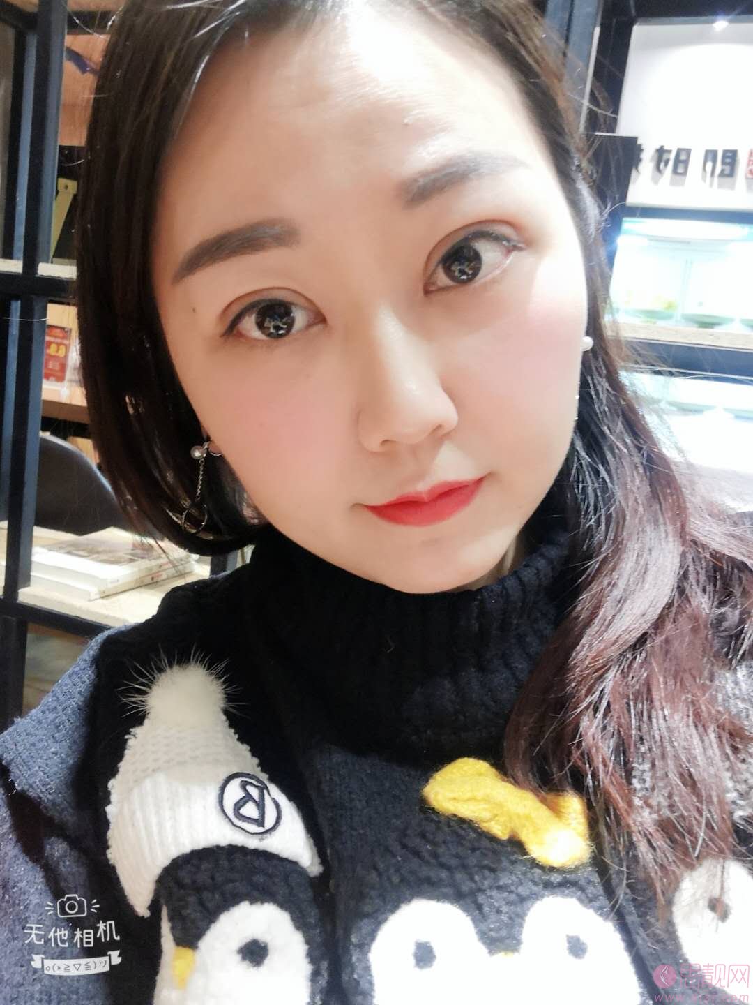 八大处陈江庭做双眼皮怎么样？附双眼皮案例一览