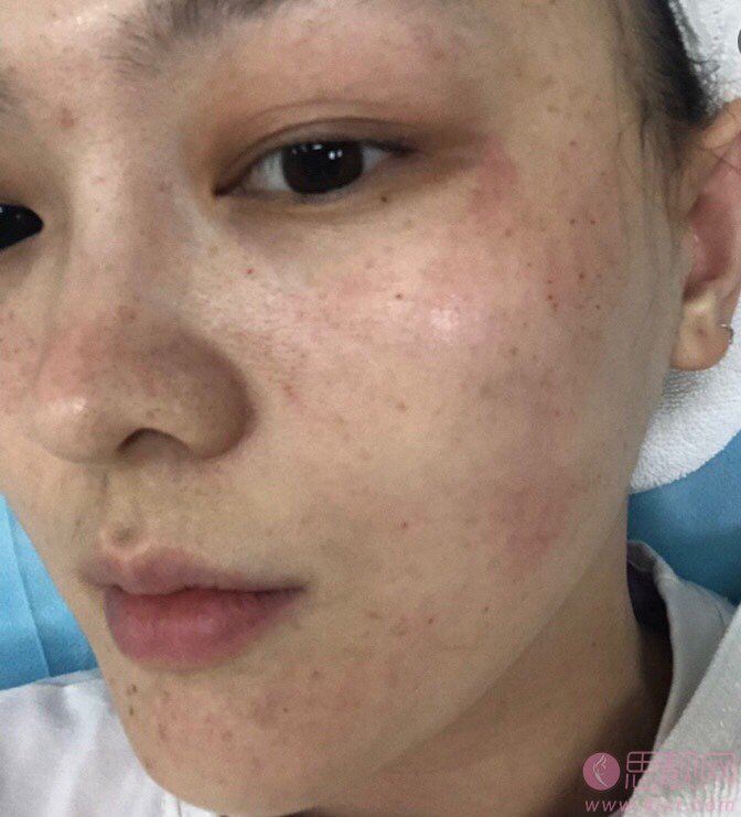 大连维恩医疗美容水光针怎么样，附价格表表一览