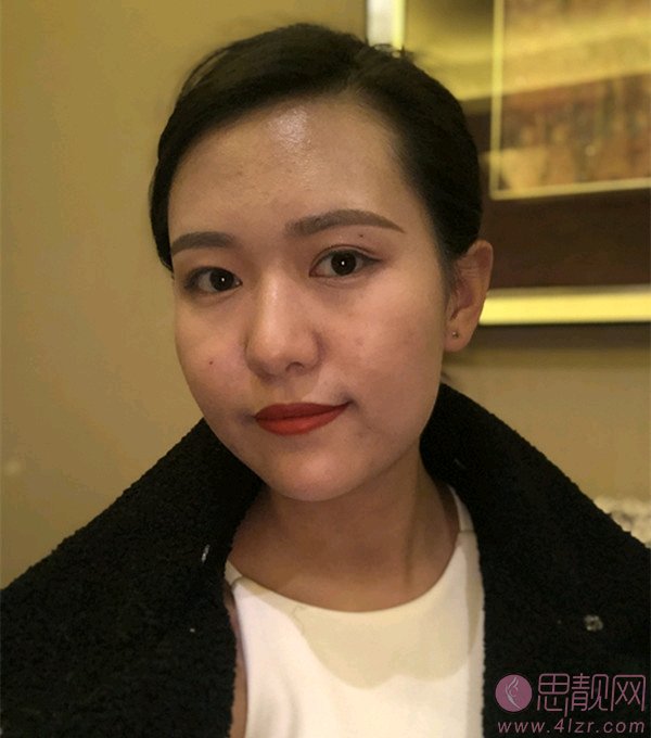 泉州西华整形医院价格表,附激光祛黑眼圈效果展示