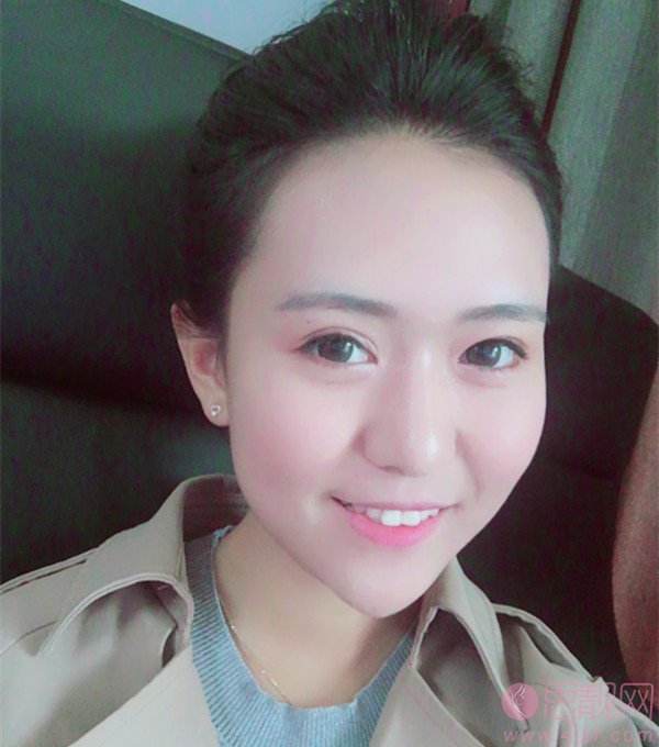 泉州西华整形医院价格表,附激光祛黑眼圈效果展示