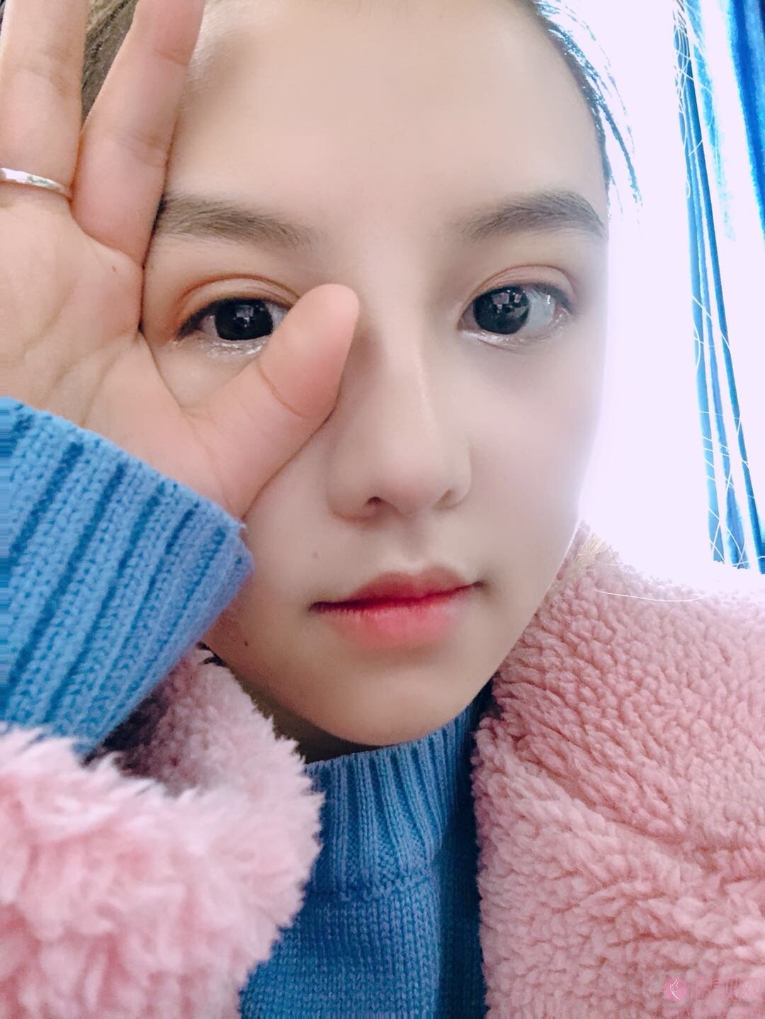 成都美极整形王伟鼻整形案例展示，附价格表查询