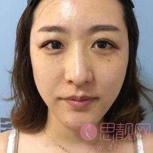 青岛庞东剑做双眼皮好吗？附案例及价格表