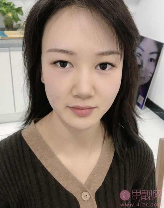 西安第二附属医院美容科陈杰隆鼻怎么样?附价格表及隆鼻效果展示
