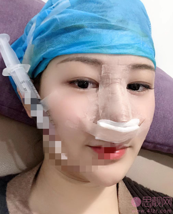 西安第二附属医院美容科陈杰隆鼻怎么样?附价格表及隆鼻效果展示